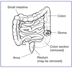 colotomy