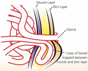 hernia