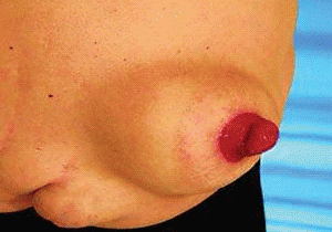 hernia2