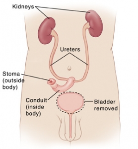 Male torso with kidneys, ureters, and urethra showing total cystectomy with incontinent urinary diversion SOURCE: Pickup from 60550A_1 kidneys, ureters, silhouette from 116226. Some elements also used in Exit Writer 116663 Urethritis and 116457 http://my.clevelandclinic.org/services/urinary_reconstruction_and_diversion/hic_urinary_reconstruction_and_diversion.aspx Smith's General Urology 16th ed.