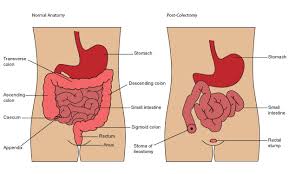 urostomy